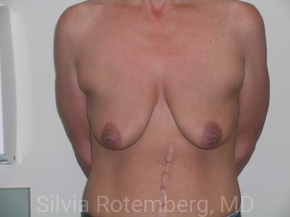Breast Lift Before & After Patient #363