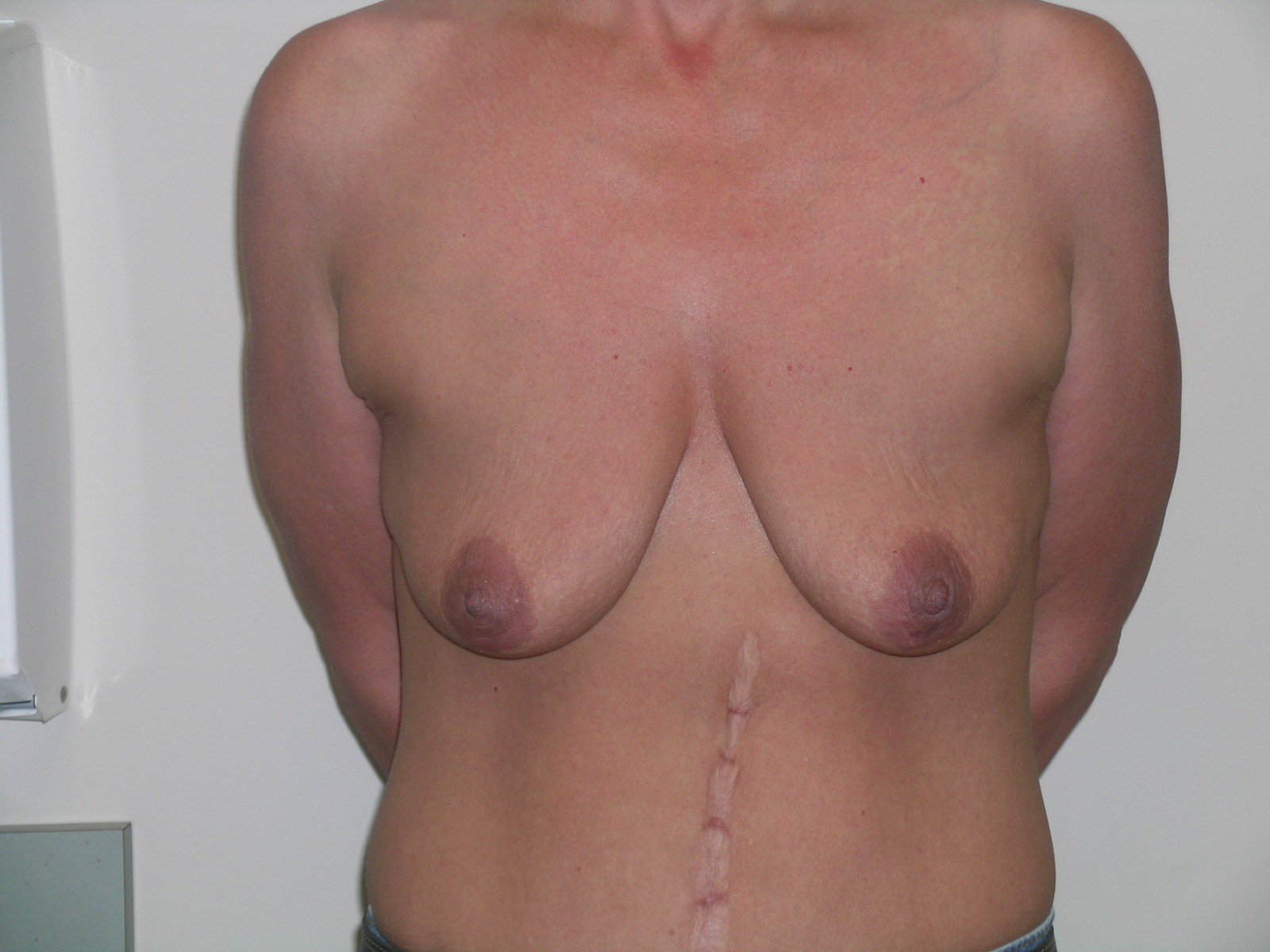 Breast Lift Before & After Patient #363