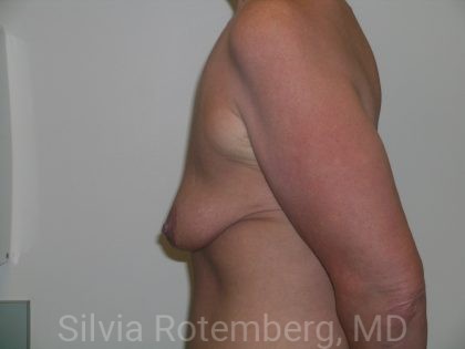 Breast Lift Before & After Patient #363