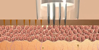 skinpen microneedling
