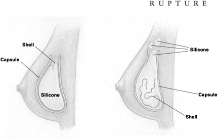 implant-rupture