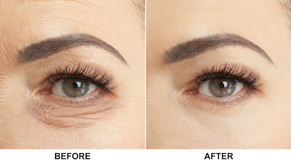 Lower Blepharoplasty