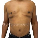 Gynecomastia Before & After Patient #3268