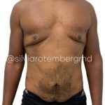 Gynecomastia Before & After Patient #3268