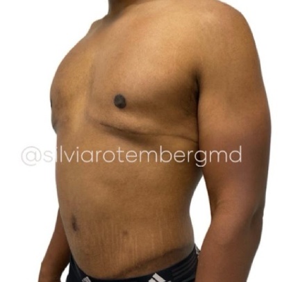 Gynecomastia Before & After Patient #3268