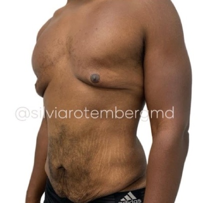 Gynecomastia Before & After Patient #3268