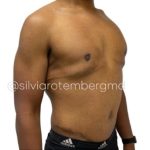 Gynecomastia Before & After Patient #3268