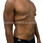 Gynecomastia Before & After Patient #3268