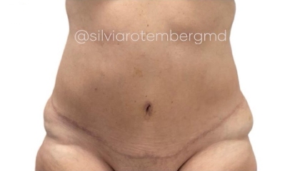 Tummy Tuck Before & After Patient #3218
