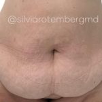Tummy Tuck Before & After Patient #3305