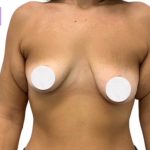 Breast Lift Before & After Patient #3266