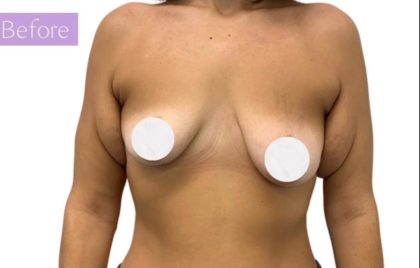 Breast Lift Before & After Patient #3266