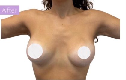 Breast Lift Before & After Patient #3266