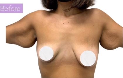 Breast Lift Before & After Patient #3266