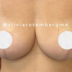 Breast Reduction Before & After Patient #3267