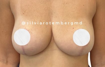 Breast Reduction Before & After Patient #3267