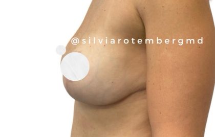 Breast Reduction Before & After Patient #3267