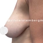 Breast Reduction Before & After Patient #3267