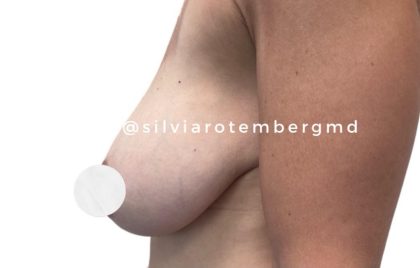 Breast Reduction Before & After Patient #3267