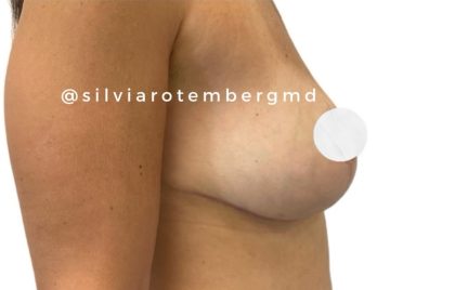 Breast Reduction Before & After Patient #3267