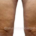 Bilateral Thigh Lift Before & After Patient #3281