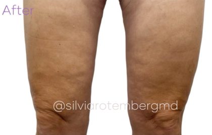 Bilateral Thigh Lift Before & After Patient #3281