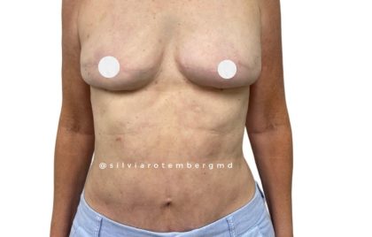 Breast Reconstruction Before & After Patient #3282
