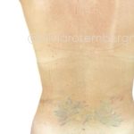 Liposuction 360 Before & After Patient #3296