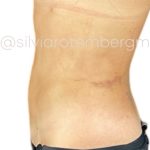 Liposuction 360 Before & After Patient #3296