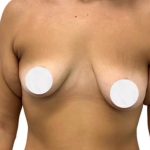 Breast Lift Before & After Patient #3473