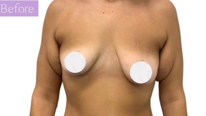 Breast Lift Before & After Patient #3473