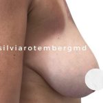 Bilateral Breast Reduction Before & After Patient #3474
