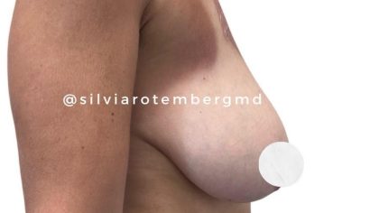 Bilateral Breast Reduction Before & After Patient #3474