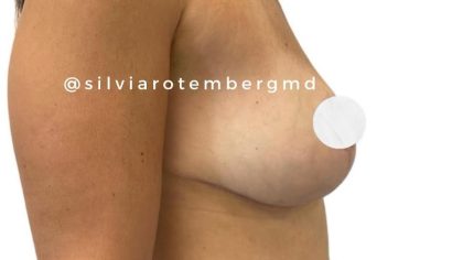 Bilateral Breast Reduction Before & After Patient #3474