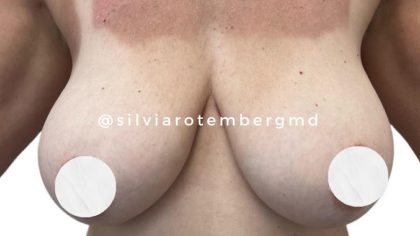 Bilateral Breast Reduction Before & After Patient #3474