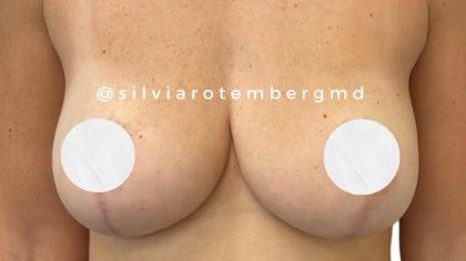 Bilateral Breast Reduction Before & After Patient #3474