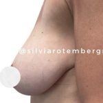 Bilateral Breast Reduction Before & After Patient #3474