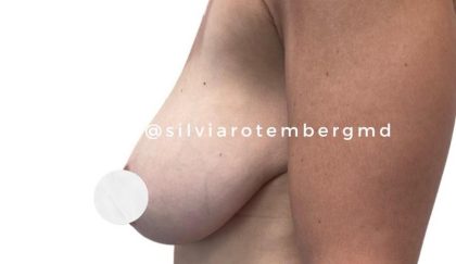 Bilateral Breast Reduction Before & After Patient #3474