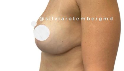 Bilateral Breast Reduction Before & After Patient #3474