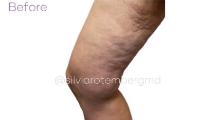 Bilateral Thigh Lift Before & After Patient #3475