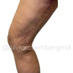 Bilateral Thigh Lift Before & After Patient #3475