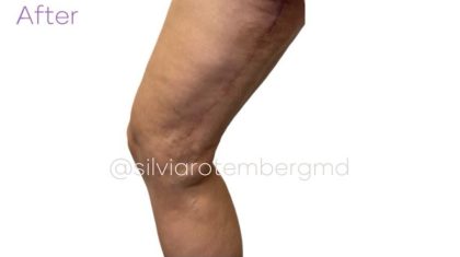 Bilateral Thigh Lift Before & After Patient #3475