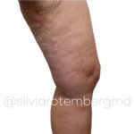 Bilateral Thigh Lift Before & After Patient #3475