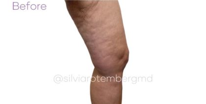 Bilateral Thigh Lift Before & After Patient #3475