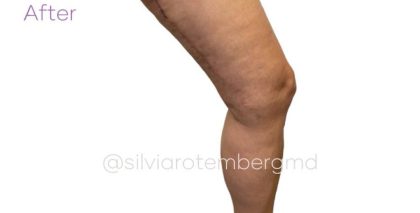 Bilateral Thigh Lift Before & After Patient #3475