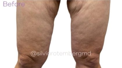 Bilateral Thigh Lift Before & After Patient #3475