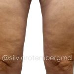 Bilateral Thigh Lift Before & After Patient #3475