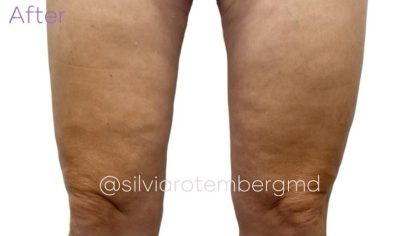 Bilateral Thigh Lift Before & After Patient #3475