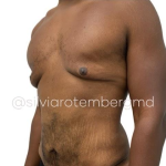 Gynecomastia Before & After Patient #3477