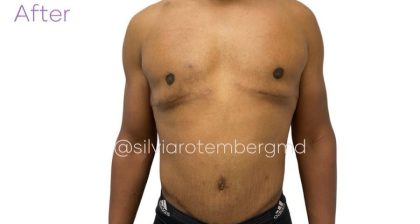 Gynecomastia Before & After Patient #3477